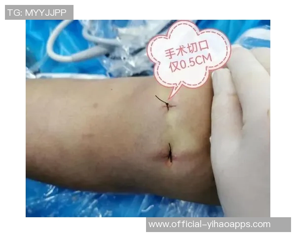 尤文图斯布雷默左膝半月板受伤将接受手术切除部分组织